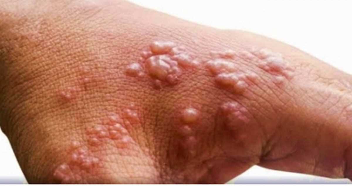 दिल्ली में मंकीपॉक्स का पहला मामला सामने आया